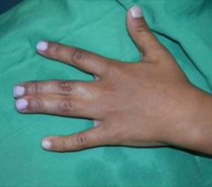 Syndactyly1-1