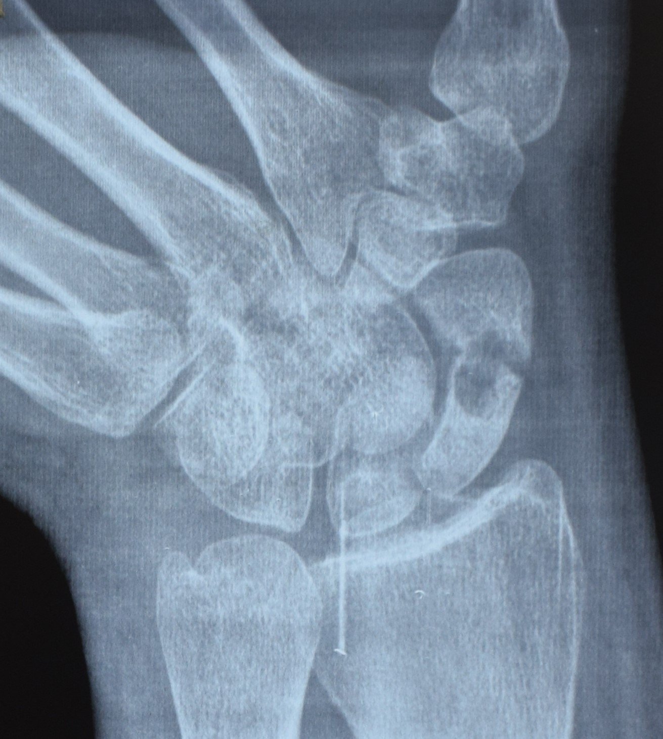 Scaphoid Fracture Treatment